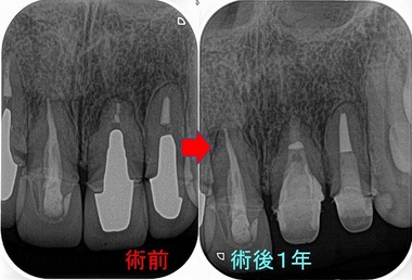 側面の根尖病変と縁下マージン - EE DENTAL_Blog